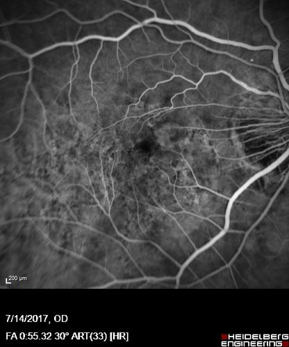 Rapid macular atrophy with anti-VEGF therapy for myopic CNVM
64 year old female with 20/32 vision and distortion in the left and better eye.  She was treated with monthly lucentis and her vision declined to 20/100.  Medicine was stopped and she improved a little to 20/80.
