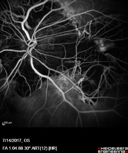 Rapid macular atrophy with anti-VEGF therapy for myopic CNVM
64 year old female with 20/32 vision and distortion in the left and better eye.  She was treated with monthly lucentis and her vision declined to 20/100.  Medicine was stopped and she improved a little to 20/80.
