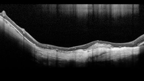Rapid macular atrophy with anti-VEGF therapy for myopic CNVM
64 year old female with 20/32 vision and distortion in the left and better eye.  She was treated with monthly lucentis and her vision declined to 20/100.  Medicine was stopped and she improved a little to 20/80.
