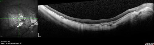 Rapid macular atrophy with anti-VEGF therapy for myopic CNVM
64 year old female with 20/32 vision and distortion in the left and better eye.  She was treated with monthly lucentis and her vision declined to 20/100.  Medicine was stopped and she improved a little to 20/80.

