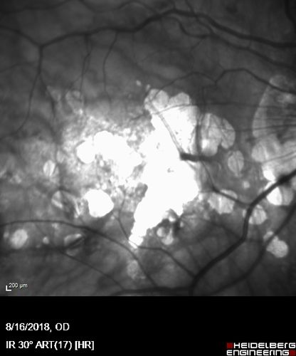 Rapid macular atrophy with anti-VEGF therapy for myopic CNVM
64 year old female with 20/32 vision and distortion in the left and better eye.  She was treated with monthly lucentis and her vision declined to 20/100.  Medicine was stopped and she improved a little to 20/80.
