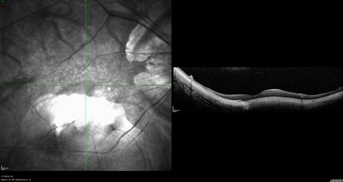 Myopic Degeneration - Inferior staphyloma with severe atrophy
76 year old with gradual vision loss.  20/32 OD; 20/40 OS
