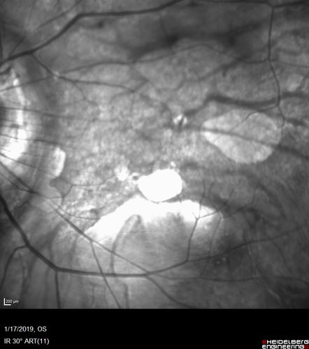 Myopic Degeneration - Inferior staphyloma with severe atrophy
76 year old with gradual vision loss.  20/32 OD; 20/40 OS
