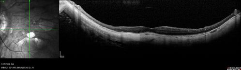 Myopic Degeneration - Inferior staphyloma with severe atrophy
76 year old with gradual vision loss.  20/32 OD; 20/40 OS
