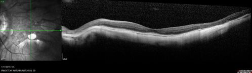 Myopic Degeneration - Inferior staphyloma with severe atrophy
76 year old with gradual vision loss.  20/32 OD; 20/40 OS
