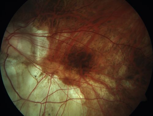Myopic CNVM in the left eye.  New Classic subfoveal lesion
64 year old female.  She had retinal detachment repair in the right eye in 1996 (25 years ago).  The left eye has new distortion for a week or two.
VA 20/40 OU.
Left eye has a very small subfoveal CNVM
