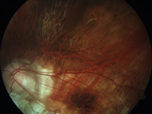 Myopic CNVM in the left eye.  New Classic subfoveal lesion
64 year old female.  She had retinal detachment repair in the right eye in 1996 (25 years ago).  The left eye has new distortion for a week or two.
VA 20/40 OU.
Left eye has a very small subfoveal CNVM
