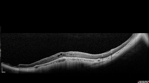 Myopic CNVM in the left eye.  New Classic subfoveal lesion
64 year old female.  She had retinal detachment repair in the right eye in 1996 (25 years ago).  The left eye has new distortion for a week or two.
VA 20/40 OU.
Left eye has a very small subfoveal CNVM
