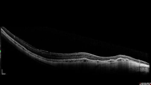 Myopic CNVM in the left eye.  New Classic subfoveal lesion
64 year old female.  She had retinal detachment repair in the right eye in 1996 (25 years ago).  The left eye has new distortion for a week or two.
VA 20/40 OU.
Left eye has a very small subfoveal CNVM
