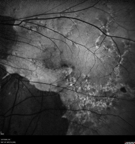 Myopic CNVM in the left eye.  New Classic subfoveal lesion
64 year old female.  She had retinal detachment repair in the right eye in 1996 (25 years ago).  The left eye has new distortion for a week or two.
VA 20/40 OU.
Left eye has a very small subfoveal CNVM
