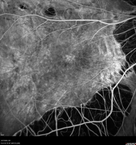 Myopic CNVM in the left eye.  New Classic subfoveal lesion
64 year old female.  She had retinal detachment repair in the right eye in 1996 (25 years ago).  The left eye has new distortion for a week or two.
VA 20/40 OU.
Left eye has a very small subfoveal CNVM

