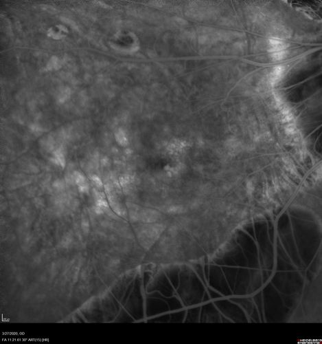 Myopic CNVM in the left eye.  New Classic subfoveal lesion
64 year old female.  She had retinal detachment repair in the right eye in 1996 (25 years ago).  The left eye has new distortion for a week or two.
VA 20/40 OU.
Left eye has a very small subfoveal CNVM
