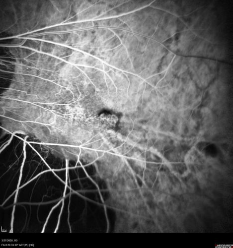 Myopic CNVM in the left eye.  New Classic subfoveal lesion
64 year old female.  She had retinal detachment repair in the right eye in 1996 (25 years ago).  The left eye has new distortion for a week or two.
VA 20/40 OU.
Left eye has a very small subfoveal CNVM
