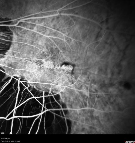 Myopic CNVM in the left eye.  New Classic subfoveal lesion
64 year old female.  She had retinal detachment repair in the right eye in 1996 (25 years ago).  The left eye has new distortion for a week or two.
VA 20/40 OU.
Left eye has a very small subfoveal CNVM
