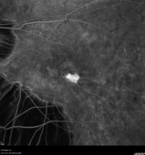 Myopic CNVM in the left eye.  New Classic subfoveal lesion
64 year old female.  She had retinal detachment repair in the right eye in 1996 (25 years ago).  The left eye has new distortion for a week or two.
VA 20/40 OU.
Left eye has a very small subfoveal CNVM
