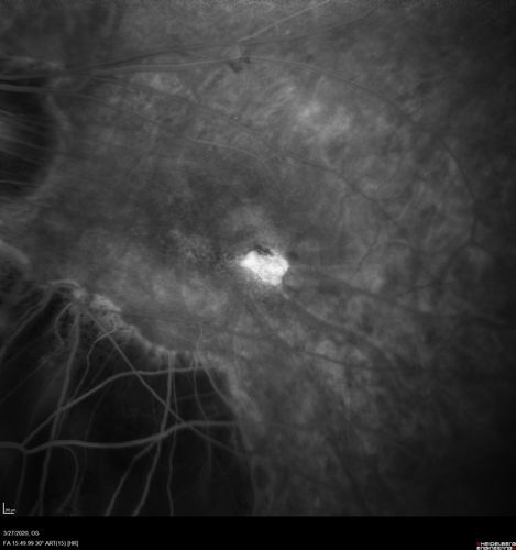 Myopic CNVM in the left eye.  New Classic subfoveal lesion
64 year old female.  She had retinal detachment repair in the right eye in 1996 (25 years ago).  The left eye has new distortion for a week or two.
VA 20/40 OU.
Left eye has a very small subfoveal CNVM
