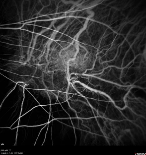 Myopic CNVM in the left eye.  New Classic subfoveal lesion
64 year old female.  She had retinal detachment repair in the right eye in 1996 (25 years ago).  The left eye has new distortion for a week or two.
VA 20/40 OU.
Left eye has a very small subfoveal CNVM
