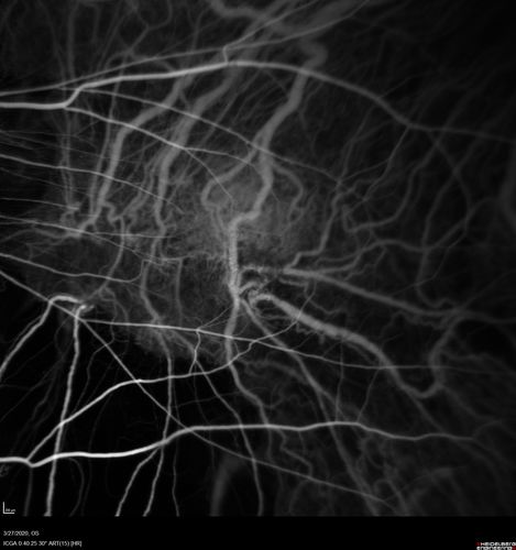 Myopic CNVM in the left eye.  New Classic subfoveal lesion
64 year old female.  She had retinal detachment repair in the right eye in 1996 (25 years ago).  The left eye has new distortion for a week or two.
VA 20/40 OU.
Left eye has a very small subfoveal CNVM
