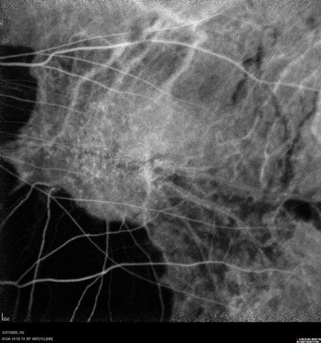 Myopic CNVM in the left eye.  New Classic subfoveal lesion
64 year old female.  She had retinal detachment repair in the right eye in 1996 (25 years ago).  The left eye has new distortion for a week or two.
VA 20/40 OU.
Left eye has a very small subfoveal CNVM
