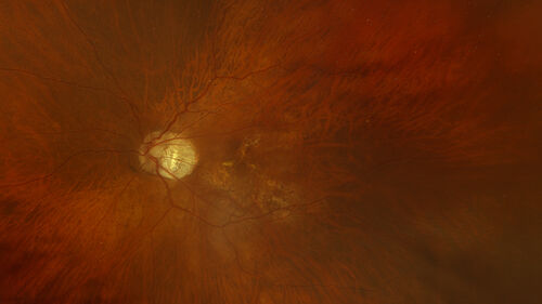 Stable Myopic Tractional Maculopathy
73 year old female with mild vision loss from table myopic tractional maculopathy in  the left eye
