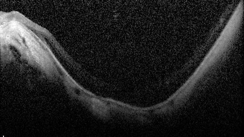 Stable Myopic Tractional Maculopathy
73 year old female with mild vision loss from table myopic tractional maculopathy in  the left eye
