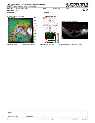 Stable Myopic Tractional Maculopathy
73 year old female with mild vision loss from table myopic tractional maculopathy in  the left eye
