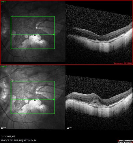 Myopic CNVM Left Eye
80 year old female.  VA dropped to 20/125 but improved back up to 20/50 with Vabysmo
