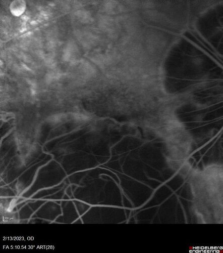 Myopic CNVM Left Eye
80 year old female.  VA dropped to 20/125 but improved back up to 20/50 with Vabysmo
