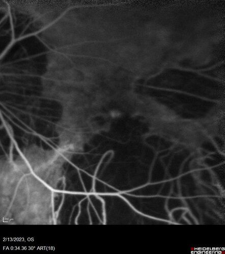 Myopic CNVM Left Eye
80 year old female.  VA dropped to 20/125 but improved back up to 20/50 with Vabysmo
