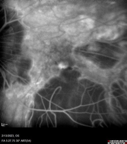 Myopic CNVM Left Eye
80 year old female.  VA dropped to 20/125 but improved back up to 20/50 with Vabysmo

