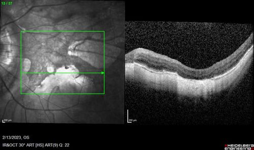 Myopic CNVM Left Eye
80 year old female.  VA dropped to 20/125 but improved back up to 20/50 with Vabysmo
