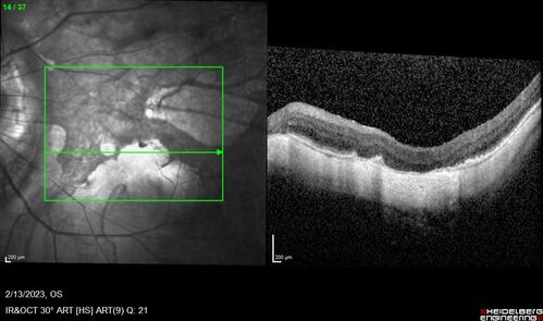 Myopic CNVM Left Eye
80 year old female.  VA dropped to 20/125 but improved back up to 20/50 with Vabysmo
