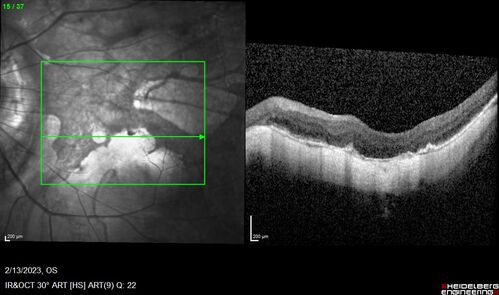 Myopic CNVM Left Eye
80 year old female.  VA dropped to 20/125 but improved back up to 20/50 with Vabysmo
