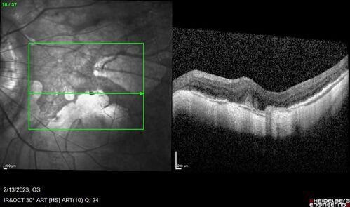 Myopic CNVM Left Eye
80 year old female.  VA dropped to 20/125 but improved back up to 20/50 with Vabysmo
