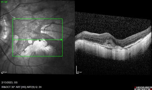 Myopic CNVM Left Eye
80 year old female.  VA dropped to 20/125 but improved back up to 20/50 with Vabysmo
