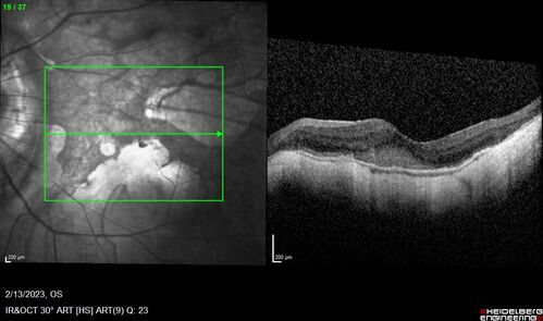 Myopic CNVM Left Eye
80 year old female.  VA dropped to 20/125 but improved back up to 20/50 with Vabysmo

