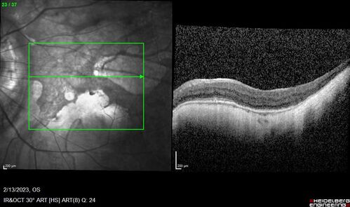 Myopic CNVM Left Eye
80 year old female.  VA dropped to 20/125 but improved back up to 20/50 with Vabysmo
