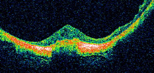 Myopic Macular Degeneration - Staphyloma - Recent Vision Loss Right Eye - Possible CNVM
83-year-old woman is a high myope with myopic macular degeneration.  She had a retinal detachment repair in the right eye in 1968.  I saw her in June of 2003.  She had posterior colobomas and areas of pigment epithelial atrophy.  She has noticed over the last six weeks substantial declining vision in the right eye.  Prior to that, the vision in the two eyes was about the same.  She uses Xalatan in the left eye and Alphagan in both eyes.

VISUAL ACUITY:  Vision OD is 20/160, OS is 20/40
