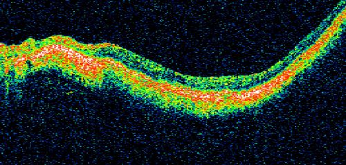 Myopic Macular Degeneration - Staphyloma - Recent Vision Loss Right Eye - Possible CNVM
83-year-old woman is a high myope with myopic macular degeneration.  She had a retinal detachment repair in the right eye in 1968.  I saw her in June of 2003.  She had posterior colobomas and areas of pigment epithelial atrophy.  She has noticed over the last six weeks substantial declining vision in the right eye.  Prior to that, the vision in the two eyes was about the same.  She uses Xalatan in the left eye and Alphagan in both eyes.

VISUAL ACUITY:  Vision OD is 20/160, OS is 20/40
