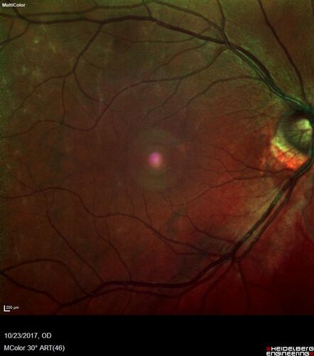 Myopic (maybe PIC) choroidal neovascular membrane with recurrence after 6 years
31 year old female presented with 20/100 vision OS in 2017.  Was treated with Lucentis x 6 and improved to 20/32.  Then she was lost to follow-up.  She represented 6 years later with 20/50 vision OS and a large recurrence and restarted treatment.
