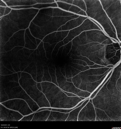 Myopic (maybe PIC) choroidal neovascular membrane with recurrence after 6 years
31 year old female presented with 20/100 vision OS in 2017.  Was treated with Lucentis x 6 and improved to 20/32.  Then she was lost to follow-up.  She represented 6 years later with 20/50 vision OS and a large recurrence and restarted treatment.
