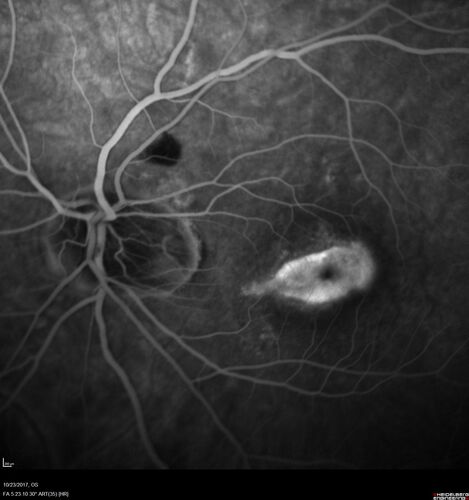 Myopic (maybe PIC) choroidal neovascular membrane with recurrence after 6 years
31 year old female presented with 20/100 vision OS in 2017.  Was treated with Lucentis x 6 and improved to 20/32.  Then she was lost to follow-up.  She represented 6 years later with 20/50 vision OS and a large recurrence and restarted treatment.
