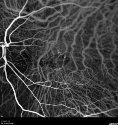 Myopic (maybe PIC) choroidal neovascular membrane with recurrence after 6 years
31 year old female presented with 20/100 vision OS in 2017.  Was treated with Lucentis x 6 and improved to 20/32.  Then she was lost to follow-up.  She represented 6 years later with 20/50 vision OS and a large recurrence and restarted treatment.
