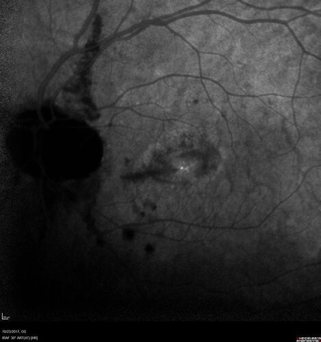 Myopic (maybe PIC) choroidal neovascular membrane with recurrence after 6 years
31 year old female presented with 20/100 vision OS in 2017.  Was treated with Lucentis x 6 and improved to 20/32.  Then she was lost to follow-up.  She represented 6 years later with 20/50 vision OS and a large recurrence and restarted treatment.
