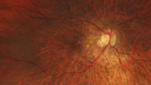 Myopic (maybe PIC) choroidal neovascular membrane with recurrence after 6 years
31 year old female presented with 20/100 vision OS in 2017.  Was treated with Lucentis x 6 and improved to 20/32.  Then she was lost to follow-up.  She represented 6 years later with 20/50 vision OS and a large recurrence and restarted treatment.
