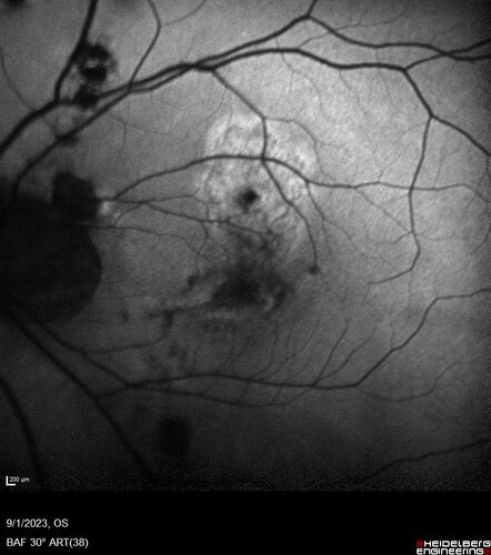 Myopic (maybe PIC) choroidal neovascular membrane with recurrence after 6 years
31 year old female presented with 20/100 vision OS in 2017.  Was treated with Lucentis x 6 and improved to 20/32.  Then she was lost to follow-up.  She represented 6 years later with 20/50 vision OS and a large recurrence and restarted treatment.
