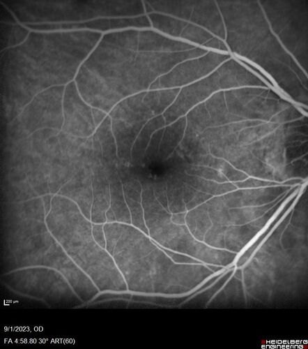 Myopic (maybe PIC) choroidal neovascular membrane with recurrence after 6 years
31 year old female presented with 20/100 vision OS in 2017.  Was treated with Lucentis x 6 and improved to 20/32.  Then she was lost to follow-up.  She represented 6 years later with 20/50 vision OS and a large recurrence and restarted treatment.
