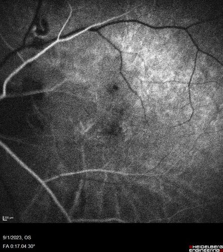 Myopic (maybe PIC) choroidal neovascular membrane with recurrence after 6 years
31 year old female presented with 20/100 vision OS in 2017.  Was treated with Lucentis x 6 and improved to 20/32.  Then she was lost to follow-up.  She represented 6 years later with 20/50 vision OS and a large recurrence and restarted treatment.
