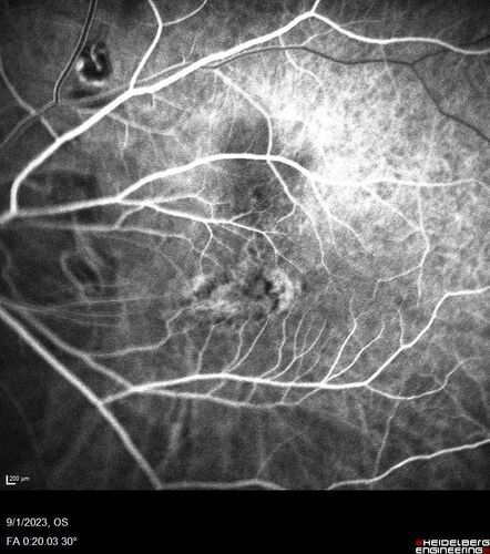 Myopic (maybe PIC) choroidal neovascular membrane with recurrence after 6 years
31 year old female presented with 20/100 vision OS in 2017.  Was treated with Lucentis x 6 and improved to 20/32.  Then she was lost to follow-up.  She represented 6 years later with 20/50 vision OS and a large recurrence and restarted treatment.
