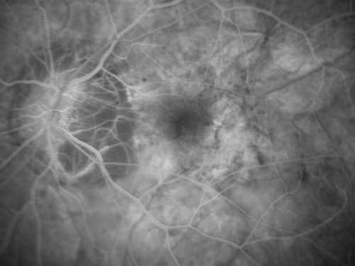 Myopic Traction Maculopathy - Vitreoretinal Traction - Possible Occult Neovascular Membrane
58-year-old woman was seen in the office on June 30, 2011. In 2002, her vision was 20/30.  Subsequent to that she had her left eye made her distance eye, which was dominate.  She had LASIK surgery on the right eye to make that her near eye and she was getting along well until about a year ago when she noticed substantial vision loss in the left eye only.  VISUAL ACUITY:  The near eye is 20/200, but she reads J2.   OS 20/100- and J16.
